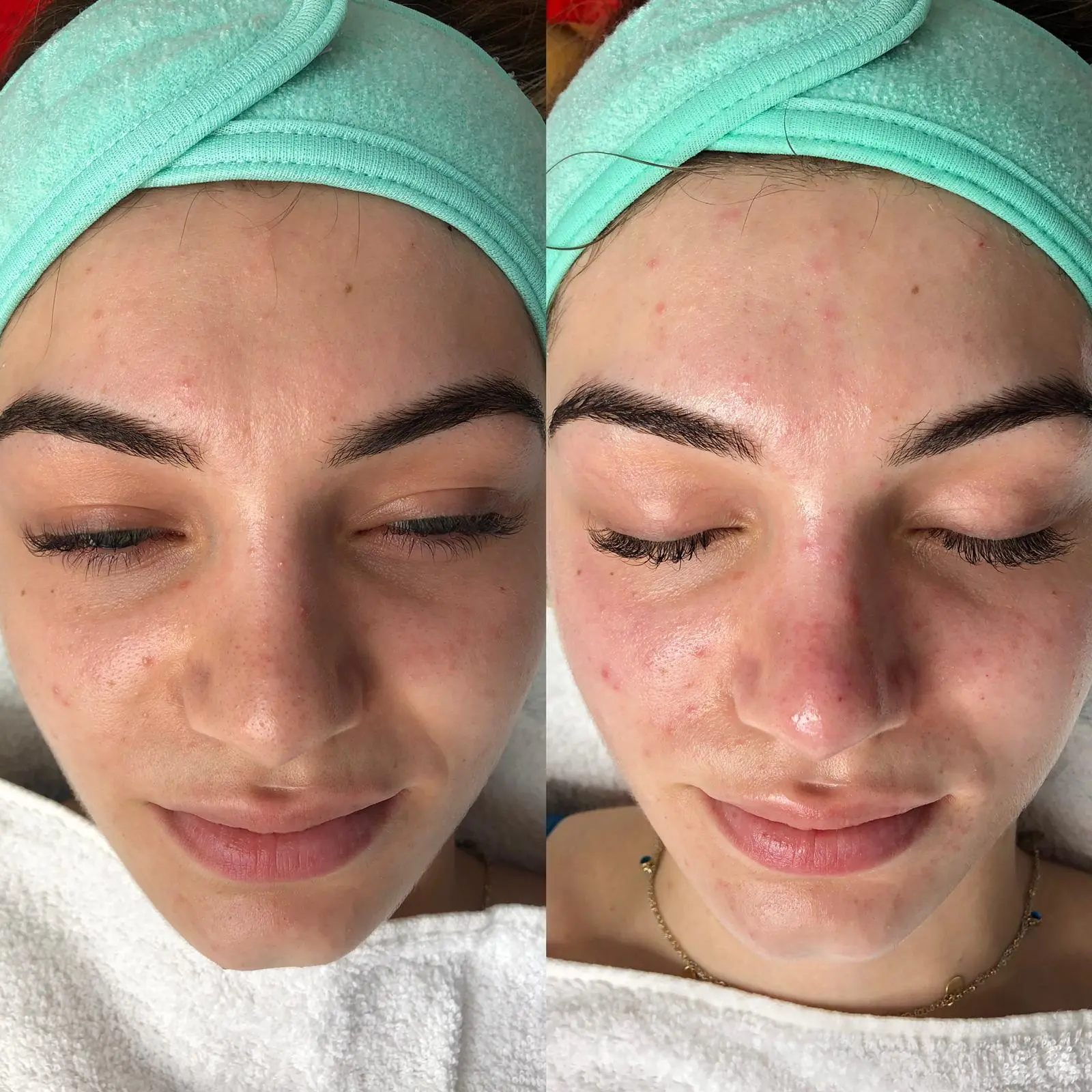 Gesichtsbehandlung bei Büsra Boz: Hautbild vor und nach der Behandlung, Kundin mit Haarband