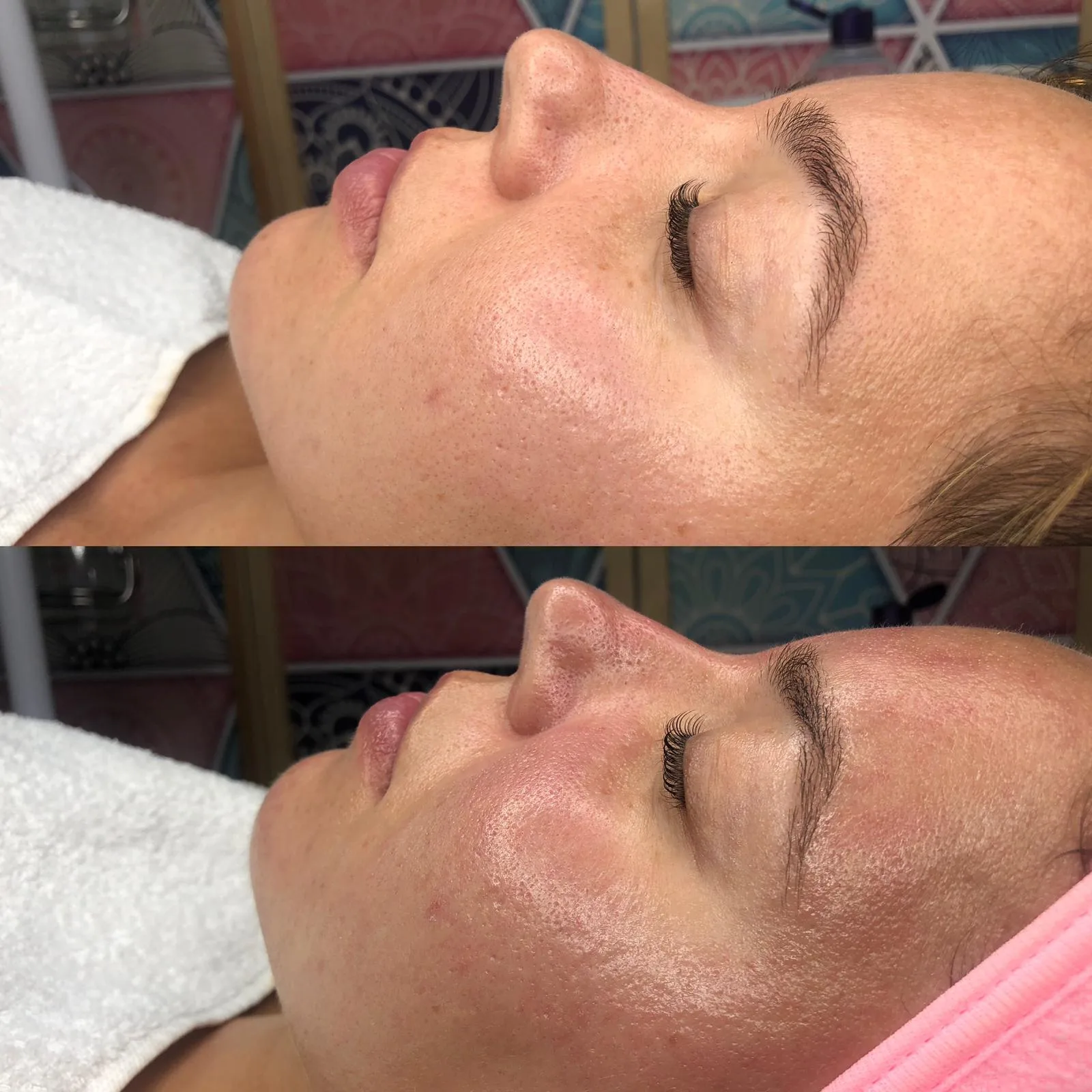 Gesicht vor und nach der Behandlung, rosafarbenes Haarband
